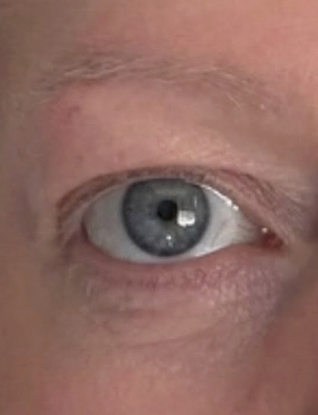 The eye area of a client of The House of Radiance, photographed before and after treatment — after
