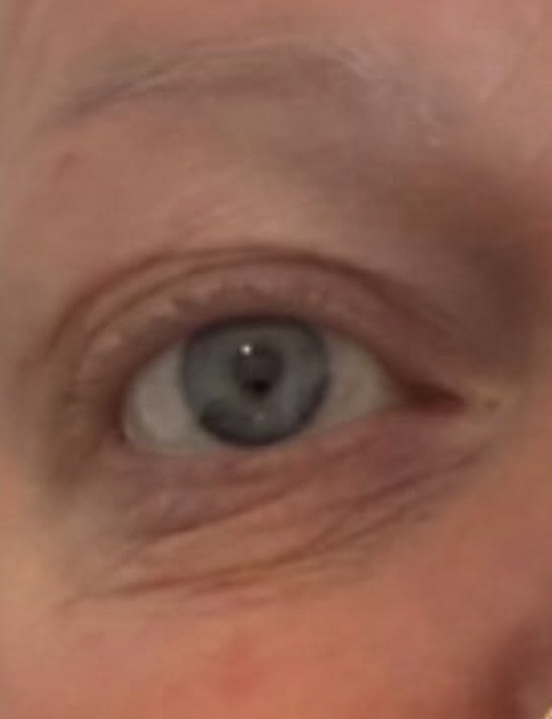 The eye area of a client of The House of Radiance, photographed before and after treatment — before